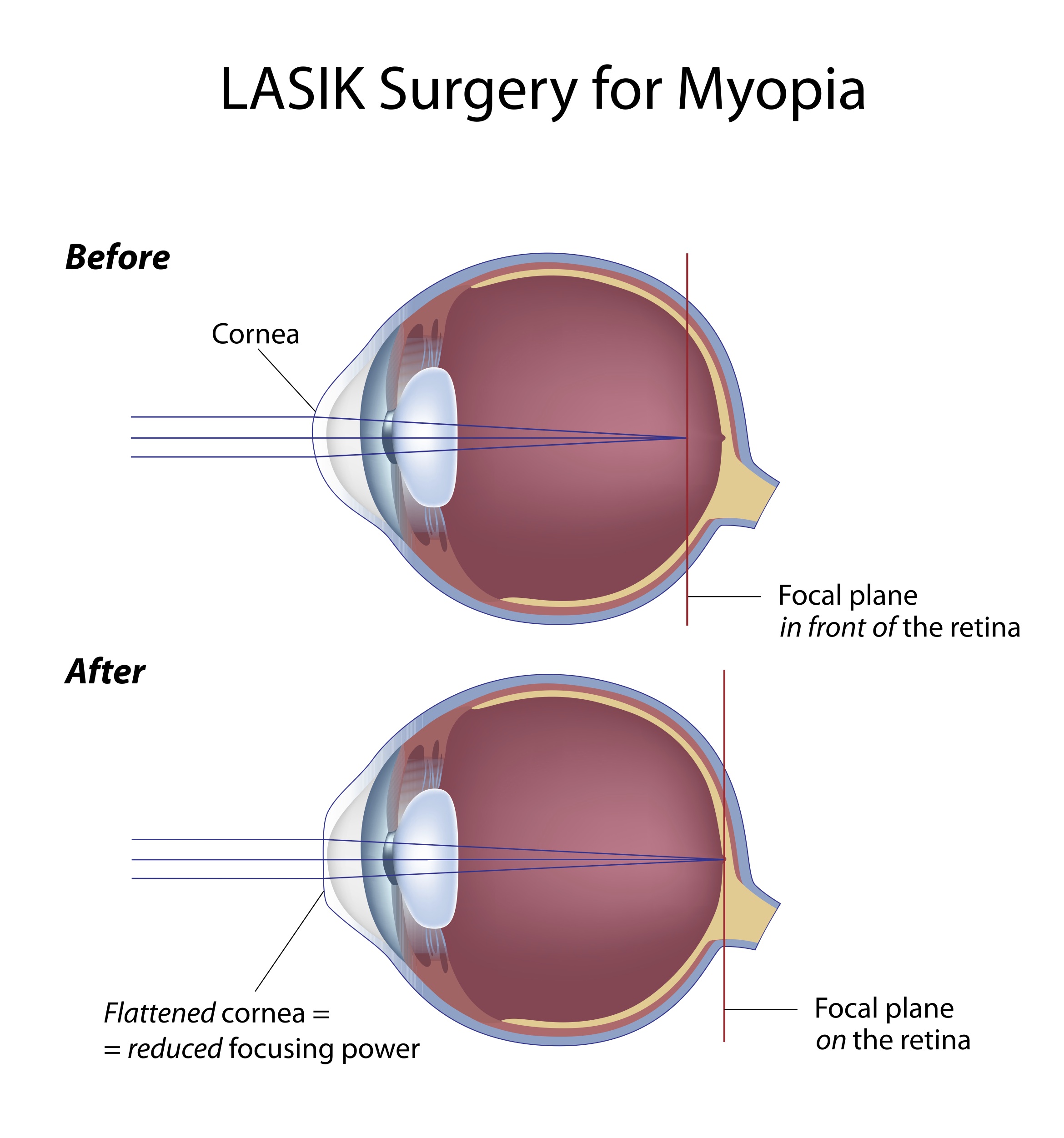 lasik1g